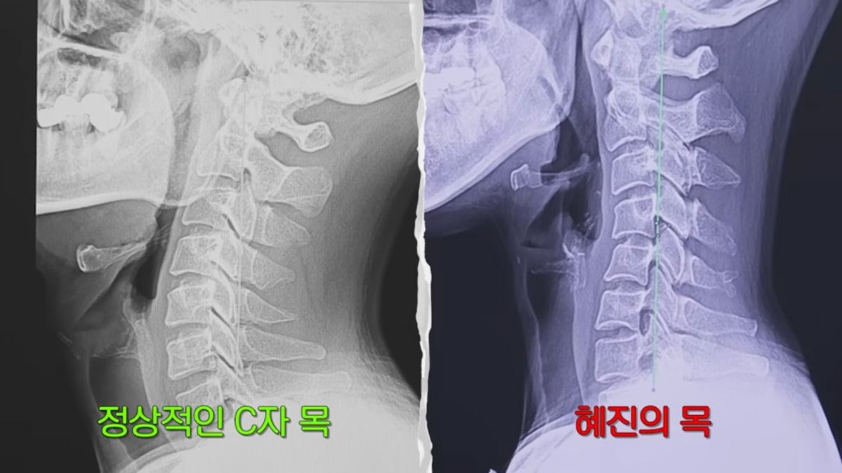 한혜진 거북목 교정 | 출처 유튜브 <한혜진>